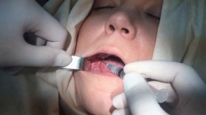 Торусальная анестезия