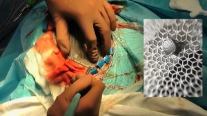 Краниопластика с индивидуальным титановым имплантатом