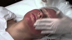 С чем сочетается микронидлинг?