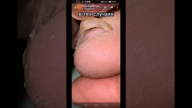 Желудочный сок гюрзы 10% от запущенного грибка ногтей. смотреть онлайн