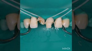 Прямая реставрация передних зубов