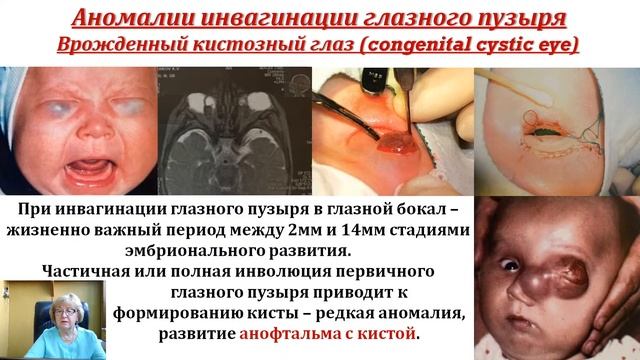 Врожденная и наследственная патология органа зрения. Часть 2. АНОФТАЛЬМ И ЦИКЛОПИЯ