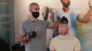 INSIDE LOOK: Crazy Scalp Micropigmentation Result