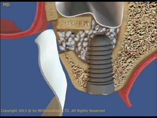 Installation of the implant, part 4 смотреть онлайн