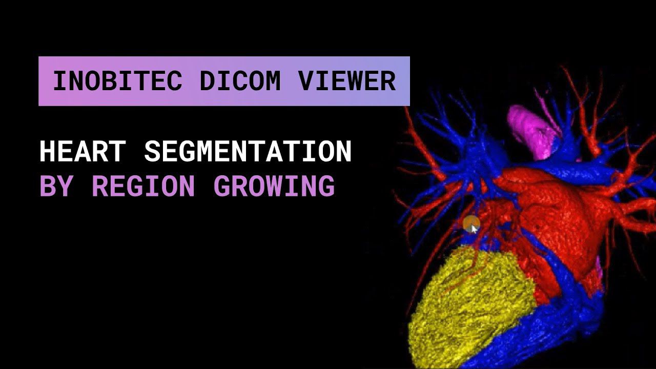 Сегментация сердца с помощью инструмента "рост региона" в Inobitec DICOM Viewer Pro