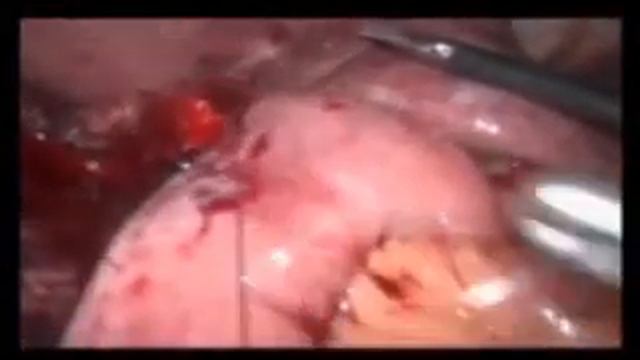 Лапароскопическая панкреатодуоденальная резекция. дмн. проф. Хатьков И.Е.(часть2) смотреть онлайн