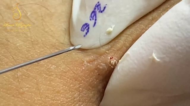 Pop goes to the sebaceous big cysts on the abdomen (266_ep1) | Loan Nguyen смотреть онлайн