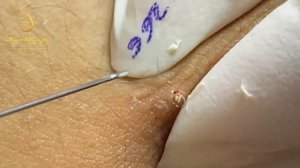 Pop goes to the sebaceous big cysts on the abdomen (266_ep1) | Loan Nguyen