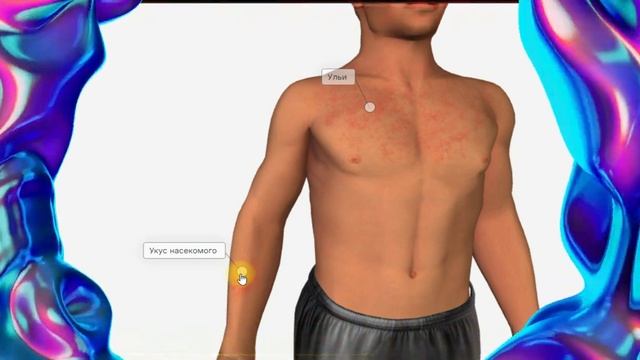 Аллергия в 3 Д атласе(анатомия человека) смотреть онлайн