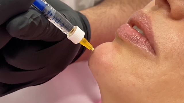 Коррекция подбородка филлерами в INNOVATION Clinic смотреть онлайн