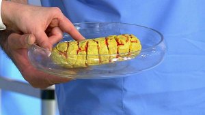 Болезни-близнецы. Рак и геморрой. Жить здорово! Фрагмент выпуска от 25.07.2016