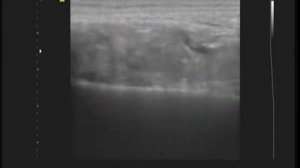 Хронический синовит с пролиферативным компонентом