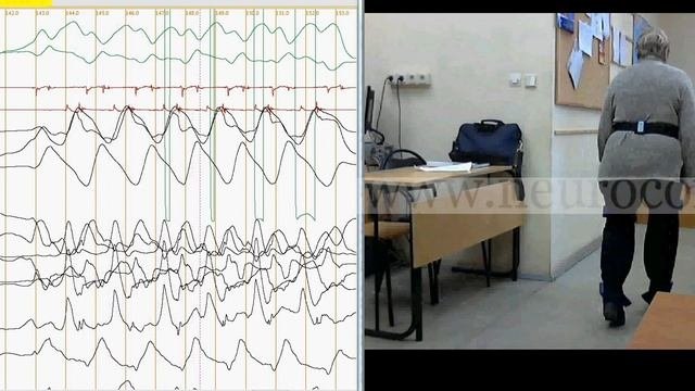 Правильное пользование тростью при гонартрозе.