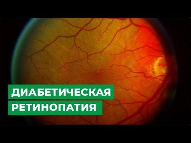 Диабетическая ретинопатия