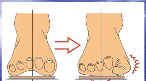 Каблуки и косточки. Вред от каблуков как предотвратить.