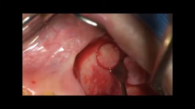 DASK Lateral approach wall off technique смотреть онлайн