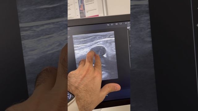 Интересный случай варикоза глубокой Вены. Флеболог Москва. Флеболог смотреть онлайн