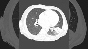 Полисегментарная пневмония