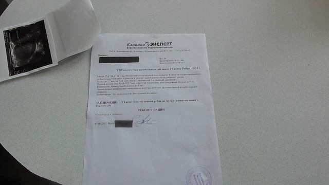 Симптом ниши. У МЕНЯ! После кесарева сечения Матка. смотреть онлайн