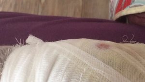 Укус кошки - это всегда опасно: глубокая рана, инфекция, отёк и нагноение.