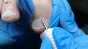 Мужской педикюр. Обработка пальцев ног. Зачистка онихолизиса. Уход за ногтями