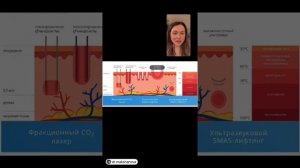 Игольчатый RF лифтинг Morpheus8/Морфеус. Как проходит процедура, рекомендации до/после, реабилитаци