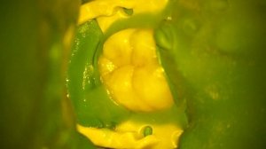 Реставрация 46 зуба (замена амальгамы на композит) direct posterior restoration