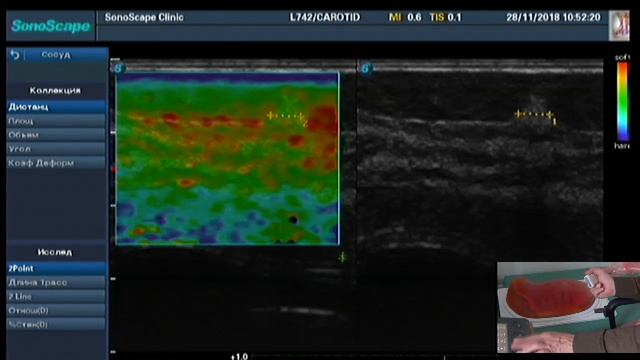 Эластография молочной железы. Практическое занятие на фантоме смотреть онлайн