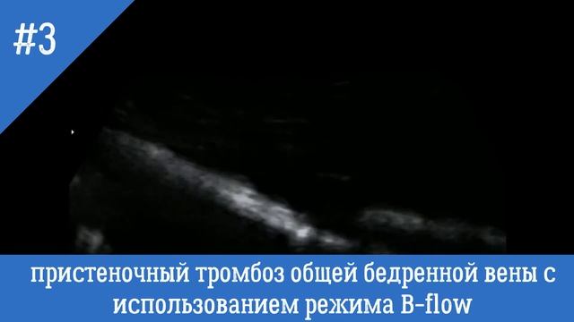 УЗИ сосудов. Локальный пристеночный тромбоз общей бедренной вены (режим B-flow)