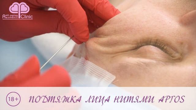 Подтяжка лица нитями APTOS