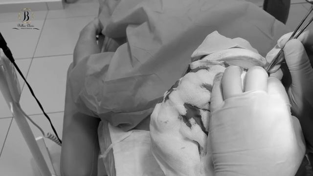 hair transplant in Bellus clinic смотреть онлайн