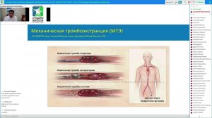 Оказание медицинской помощи пациентам с ишемическим инсультом на фоне фибрилляции предсердий