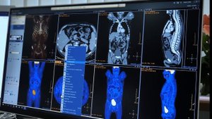 Новые возможности точной диагностики в онкологии - цифровая ПЭТ/КТ