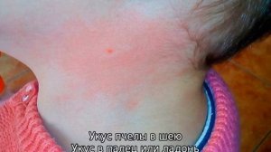 Что делать, если укусила пчела