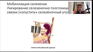 Спленэктомия: как удалить селезенку