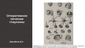 Школа глаукомы. Оперативное лечение глаукомы.
