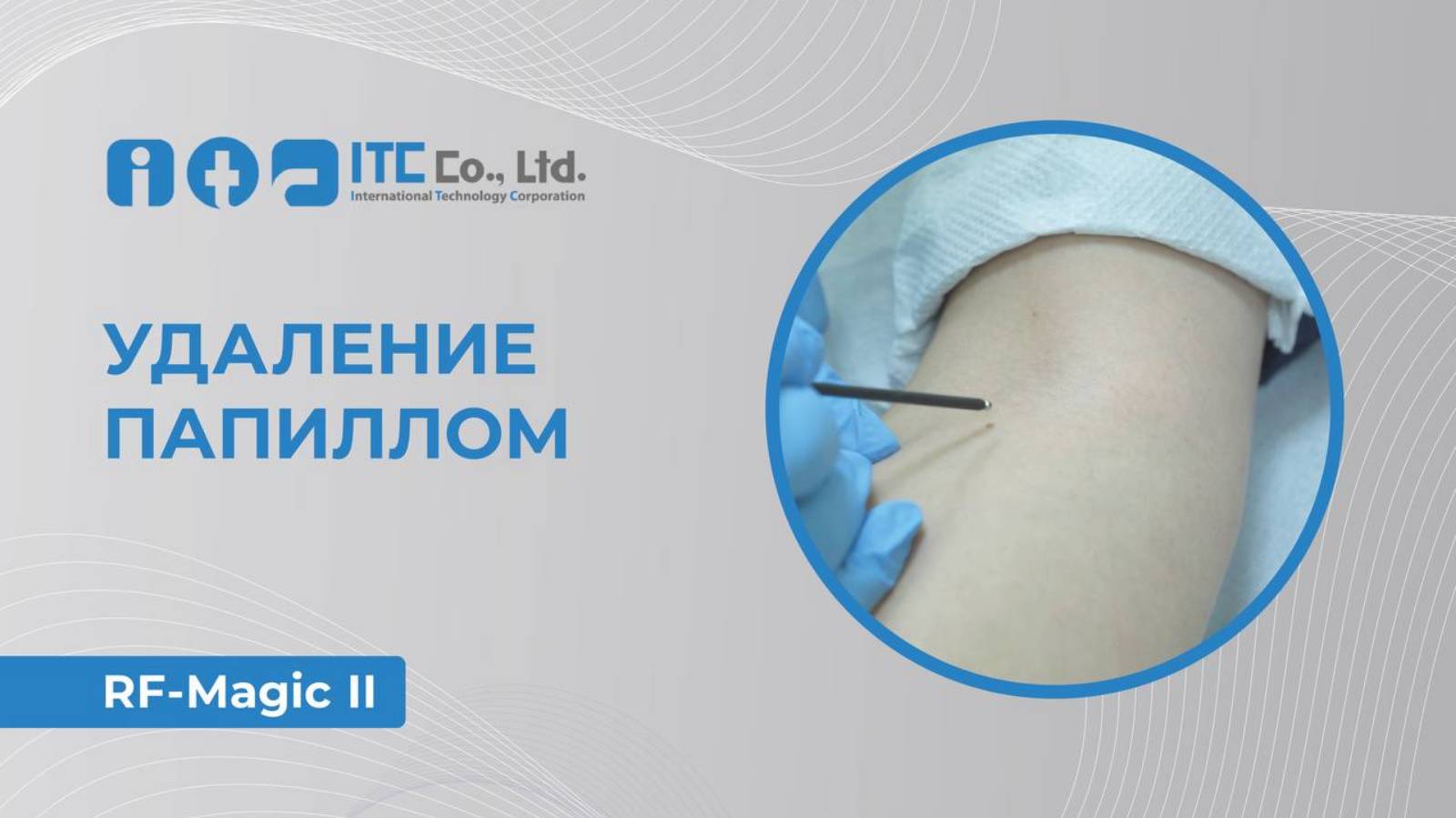 Удаление папилломы на радиоволновом аппарате.