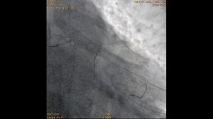 Стентирование ствола ЛКА (микрокатетер)