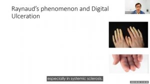 Scleroderma and Interstitial Lung Disease Webinar