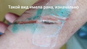 Как мумие лечит раны.