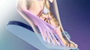 ПЛАНТАРНЫЙ ФАСЦИИТ