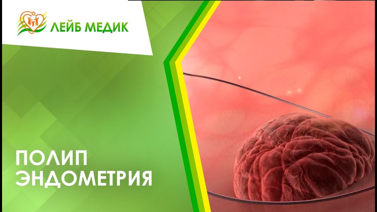 ? Полип эндометрия в матке