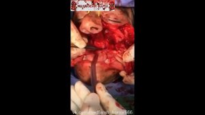 Удалили раковую опухоль в носоглотке