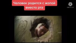 Человек Родился С Жопой Вместо Рта | У Мужика Вместо Рта Выросло Кое Что Другое