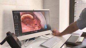 Пластика преддверия полости рта