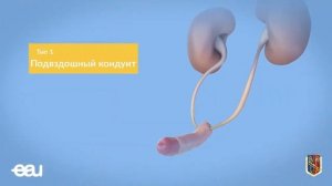 Ролик ЕАУ-РОУ "Цистэктомия (удаление мочевого пузыря)"