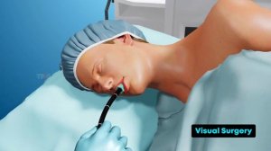 ERCP (endoscopic retrograde cholangiopancreatography) -Procedure 3D Animation