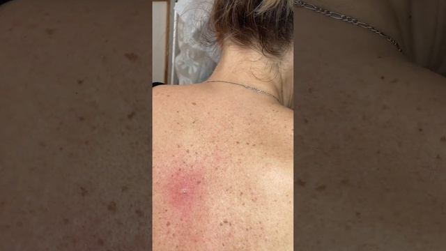 Blackheads! Угри , глубокие чёрные точки на спине . Удаление .