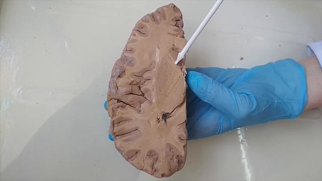 Белое вещество головного мозга , базальные ядра, капсулы, боковые желудочки смотреть онлайн