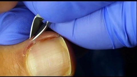 Панариций??⚠️❗️??